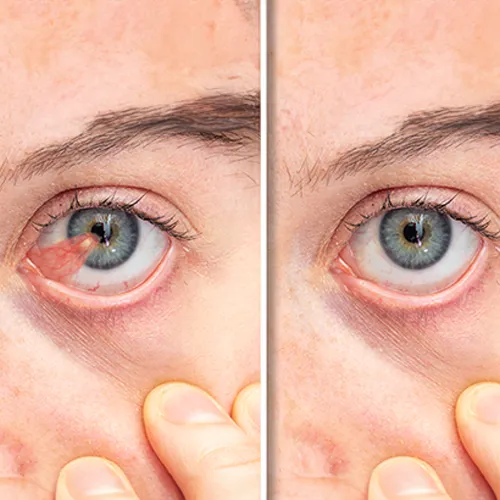 Comparativo de olho com pterígio antes e após cirurgia de remoção, mostrando melhora estética e funcional.