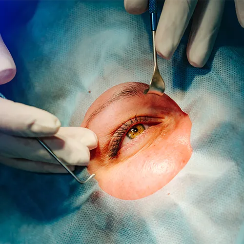 Cena cirúrgica de descolamento de retina, com equipe médica preparando o campo operatório para reparar a retina destacada.