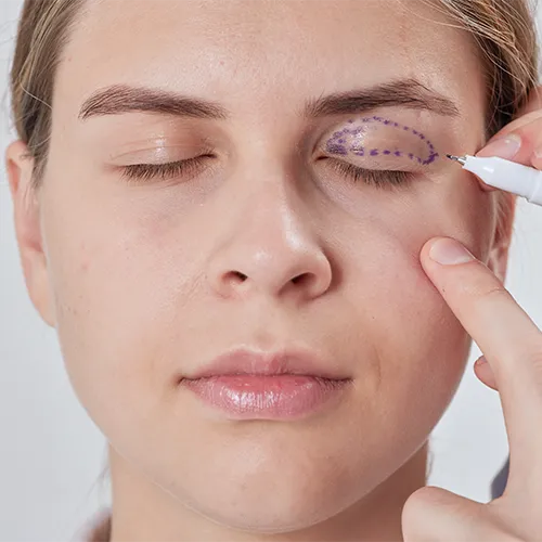 Mulher com pálpebras fechadas recebendo marcações prévias à cirurgia de pálpebra, em preparação para a blefaroplastia.