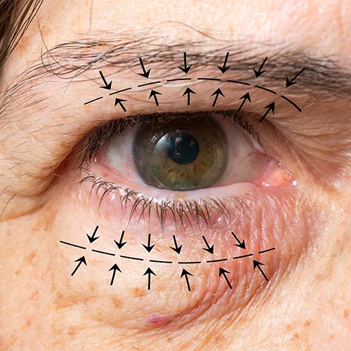 Close de olho com marcações cirúrgicas indicando áreas de intervenção em cirurgia plástica ocular nas pálpebras.