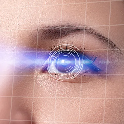 Representação do crosslinking corneano, com feixe de luz ultravioleta aplicado sobre a córnea para aumentar sua resistência e estabilizar o ceratocone.