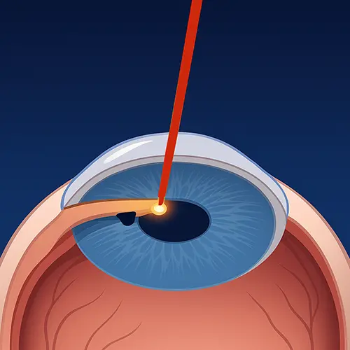 Representação detalhada da iridectomia com YAG laser, destacando o feixe vermelho criando abertura precisa na íris durante o tratamento.