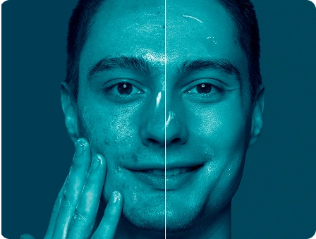 Antes de depois de peeling de fenol em uma das unidades da rede Vision One