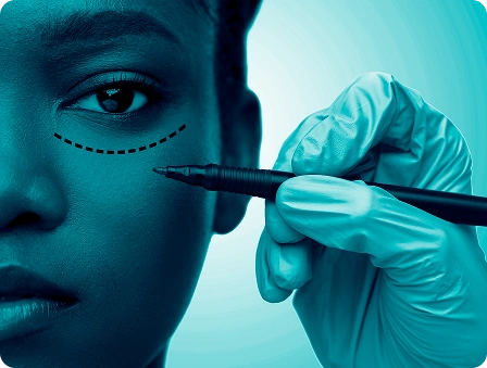 rosto de jovem é demarcado, cirurgia plástica ocular em uma das unidades da rede Vision One