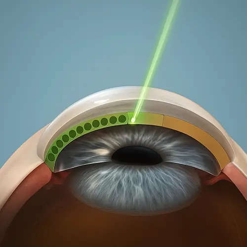 Representação do procedimento de trabeculoplastia seletiva a laser (SLT) com feixe verde direcionado para a malha trabecular do olho.