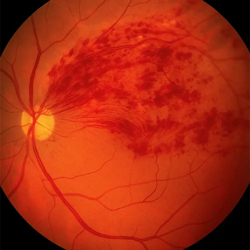 oclusões venosas na retina, especialidade médica nos hospitais de olhos da Rede Vision One