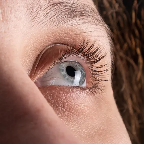 olho em formato de cone, ceratocone nos hospitais de olhos da Rede Vision One