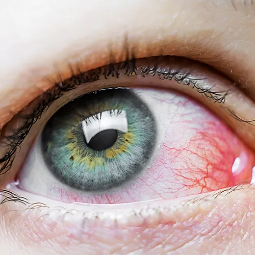 olho com irritação, conjuntivite nos hospitais de olhos da Rede Vision One