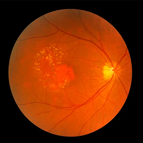 degeneração macular relacionada à idade, DMRI