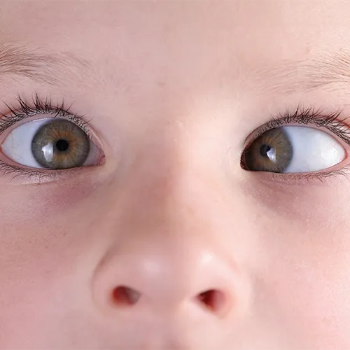 criança com olhos tortos, estrabismo nos hospitais de olhos da Rede Vision One