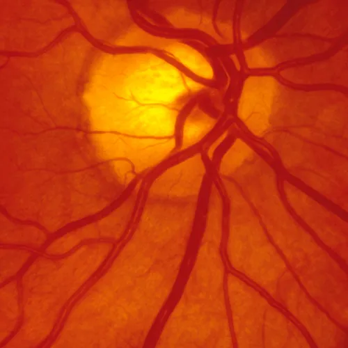 ilustração do nervo óptico