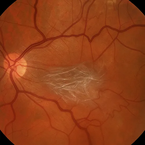 membrana epirretiniana