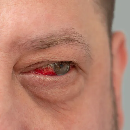 olho com retinopatia diabética