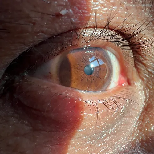 olho em detlahes, superfície ocular