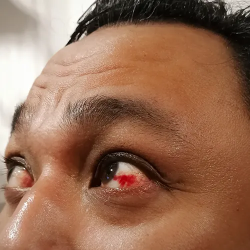 tumor ocular, homem com tumores oculares nos 2 olhos