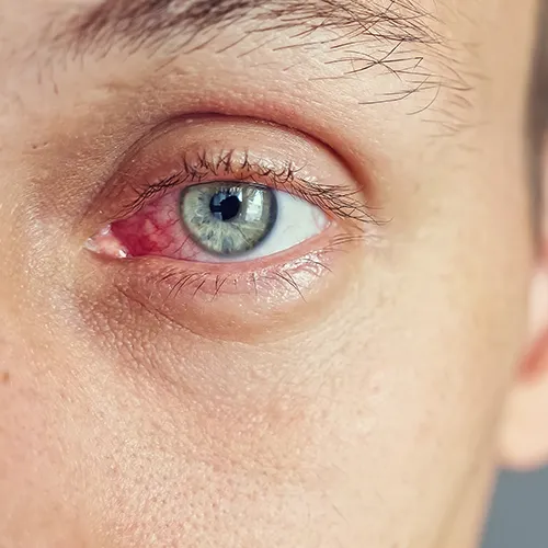 uveítes em olho verde