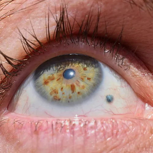 úvea, foto close-up