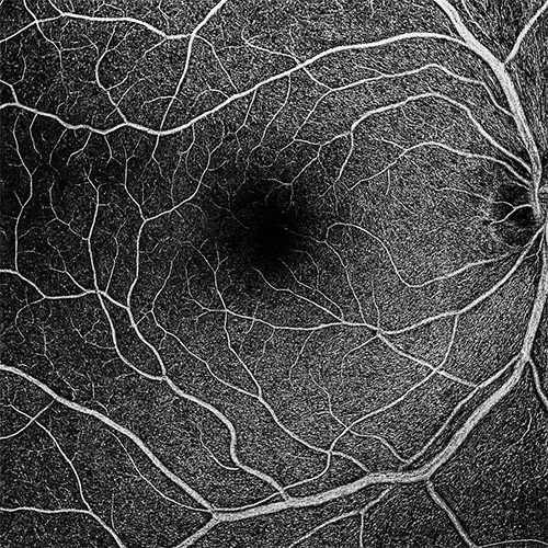Imagem de um exame oftalmológico (exame ocular) de Angiografia – análise detalhada de alterações na circulação retiniana, realizado nos hospitais de olhos da Rede Vision One.