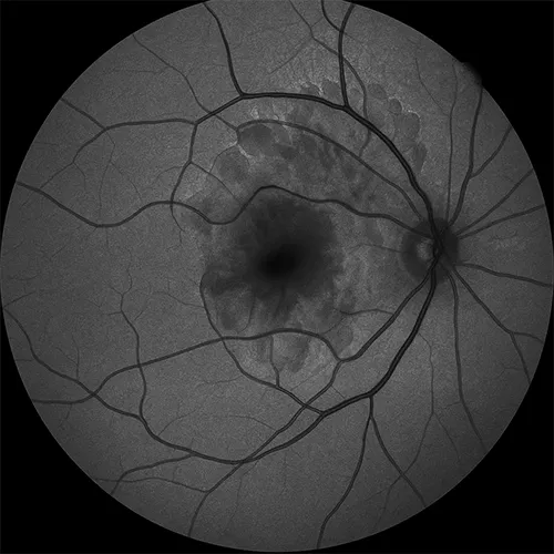 Imagem de um exame oftalmológico (exame ocular) de Autofluorescência – avaliação complementar em doenças oculares, realizado nos hospitais de olhos da Rede Vision One.