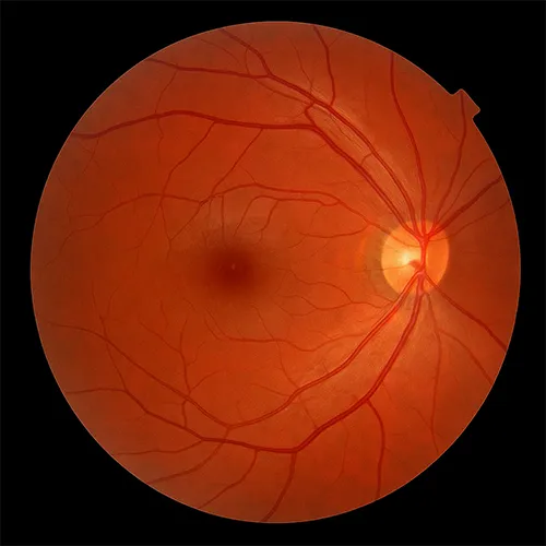 Imagem de um exame oftalmológico (exame ocular) de Retinografia – exame fotográfico do fundo de olho em alta definição, realizado nos hospitais de olhos da Rede Vision One.