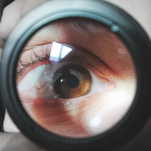 Imagem de um exame oftalmológico (exame ocular) de Fundoscopia – avaliação clínica da retina com iluminação direta, realizado nos hospitais de olhos da Rede Vision One.