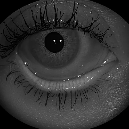 Imagem de um exame oftalmológico (exame ocular) de Meibografia – análise detalhada das glândulas lacrimais acessórias, realizado nos hospitais de olhos da Rede Vision One.