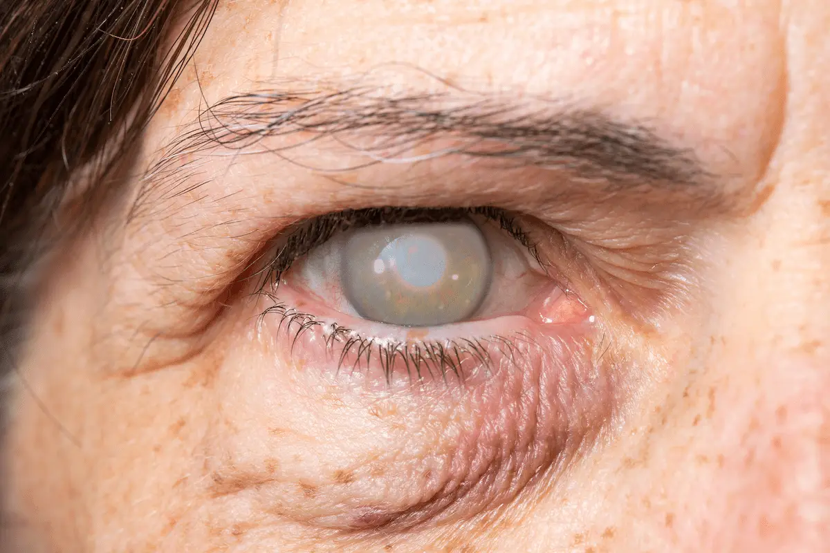 Mancha branca no olho: 7 causas que você deve conhecer