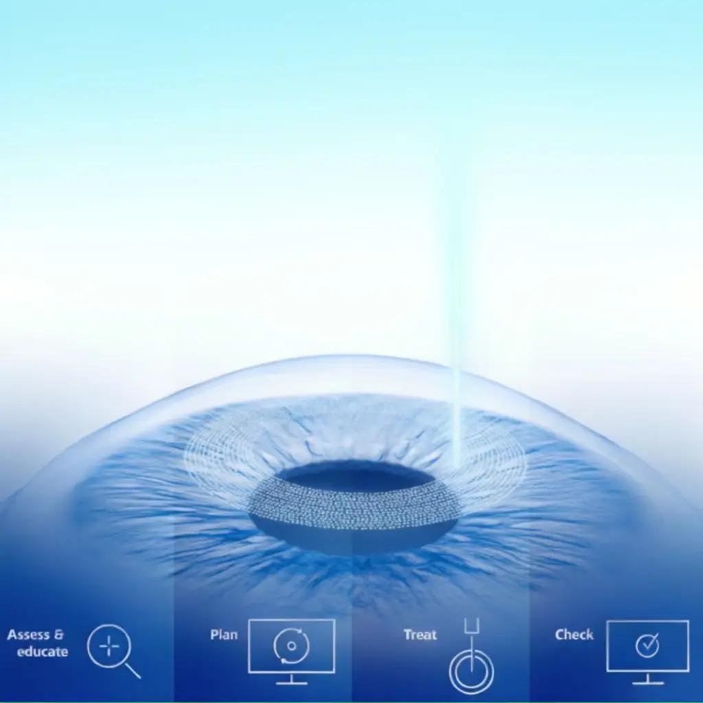 PRESBYOND laser blended vision técnica ZEISS SMILE para correção da presbiopia com visão contínua